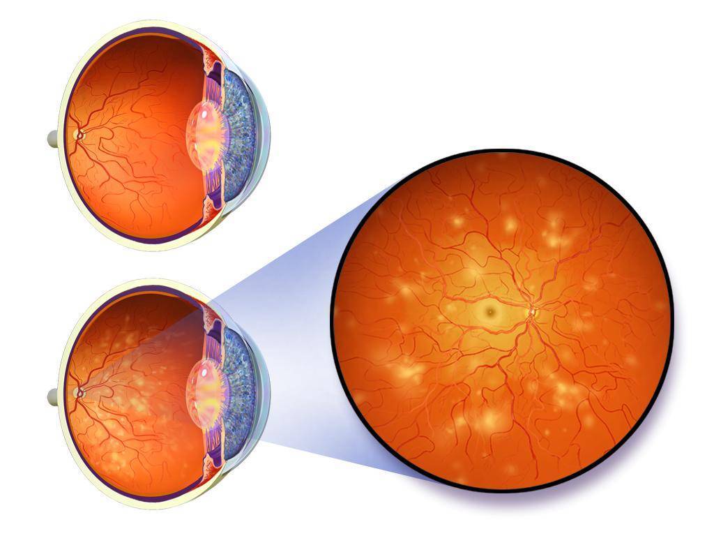 Осложнение сахарного диабета - диабетическая ретинопатия