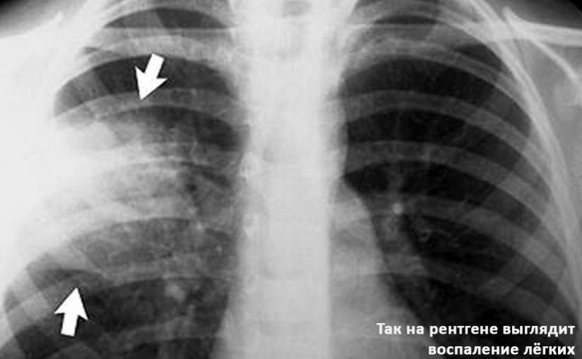 Как выглядит классический рентгеновский снимок лёгких
