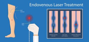 Эндовазальная лазерная коагуляция (ЭВЛК) - современное лечение варикоза