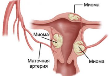 Альтернативное лечение миомы матки без радикальной операции