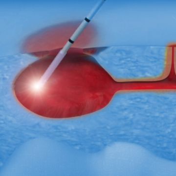 Лазерное лечение кисты копчика